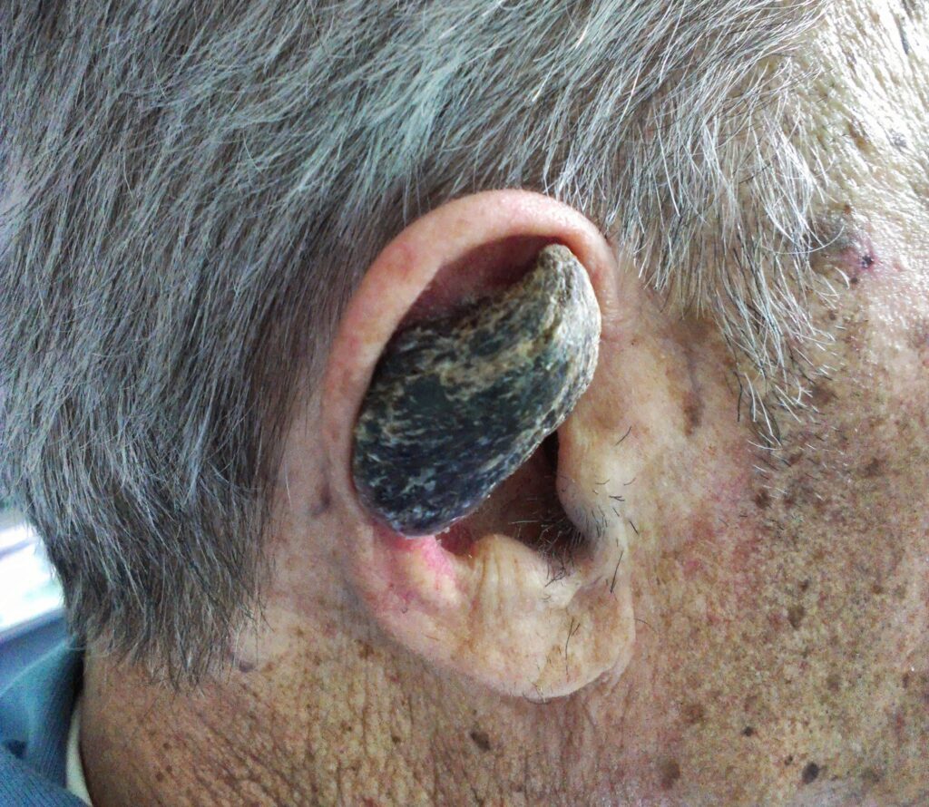 کچھ انسانوں کے سینگ کیوں اُگ آتے ہیں؟