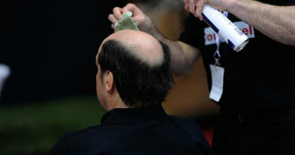 ذہنی دباؤ کا محض ایک ہی واقعہ بال گرنے کا سبب بن سکتا ہے: تحقیق